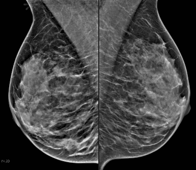 XERO breast imaging XERO breast imaging